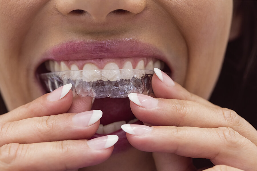 Ortodoncia invisible o brackets metálicos. ¿Cuál es la mejor opción para alinear nuestros dientes?